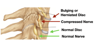 can a car accident cause a herniated disc