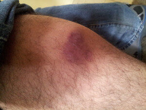 Bruising and Discoloration