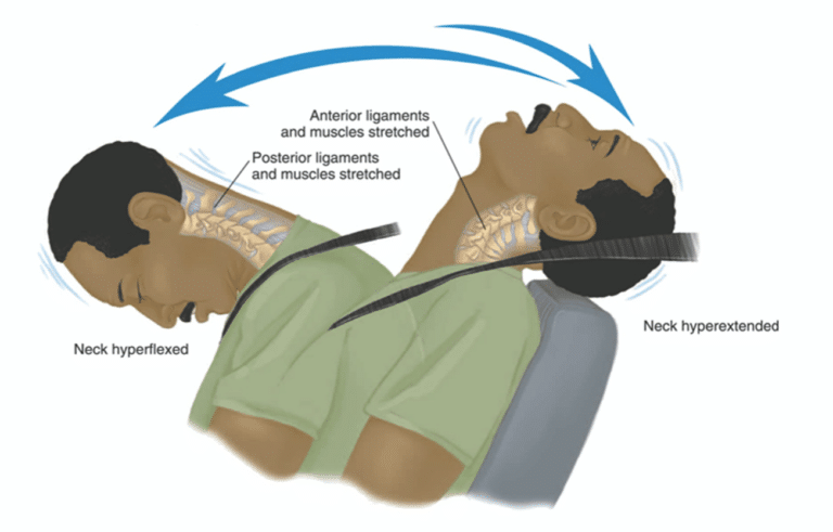 Herniated Disc
