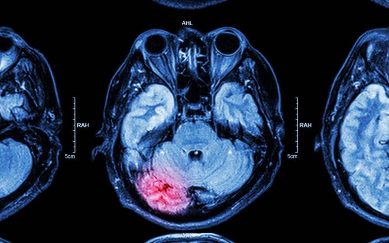 coup-contrecoup-injury